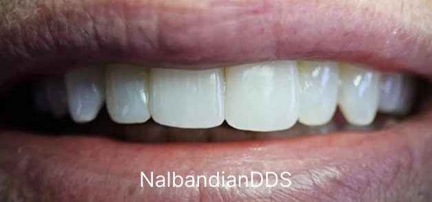 Teeth whitening after at Burbank dentist
